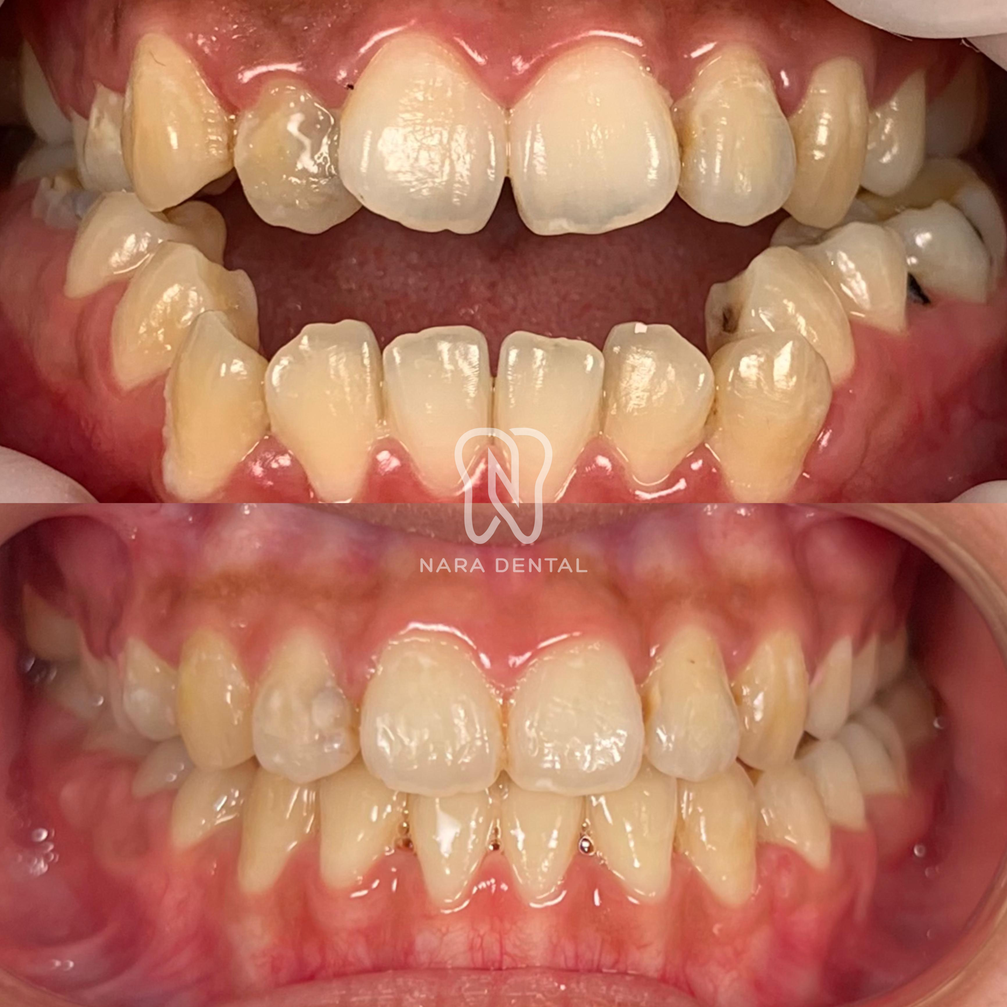 Ortodonti (Behel & Aligner)